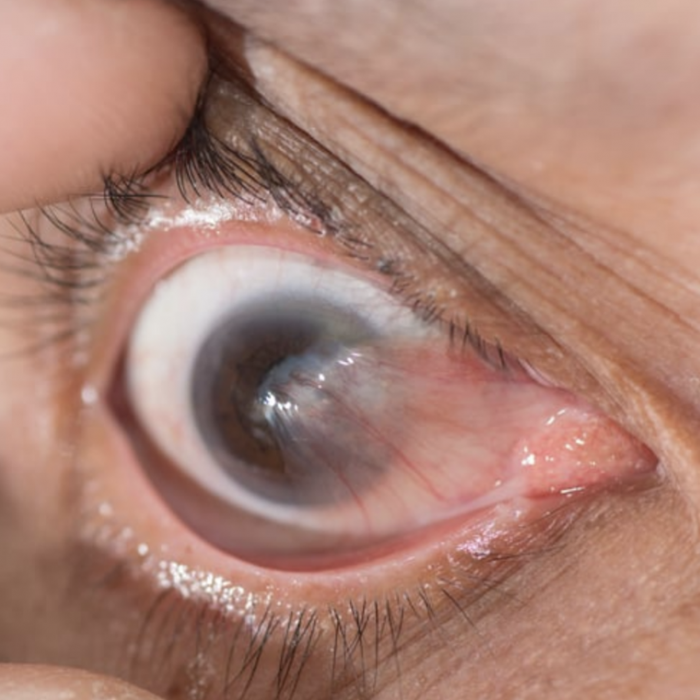 Cirugía de Pterigión