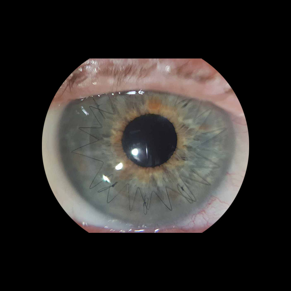 Trasplante de Córnea